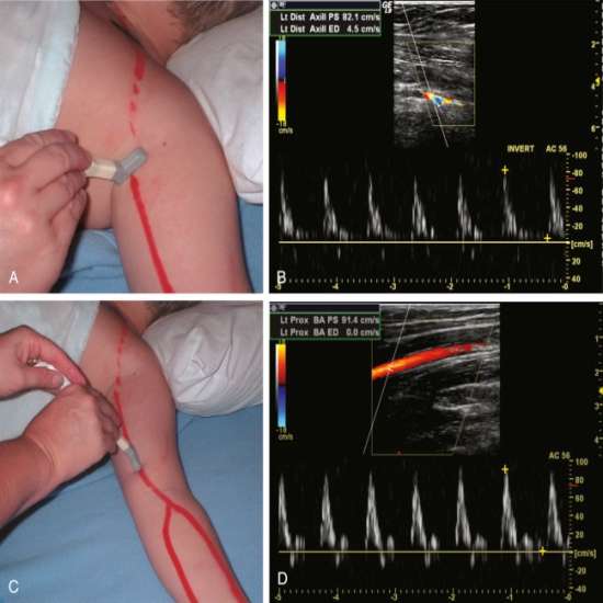 Upper limb Color Doppler : A Complete Guide, Everything You Need Know